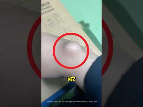 ¿Bulto en la mano? ¡Prueba esta solución! 😱